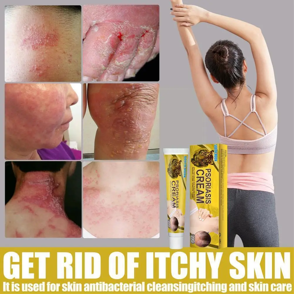 

20g Psoriasis Cream Eczema Ointment Scalp Psoriasis Tinea Hand Inhibit Foot Anti-itch Dermatitis Versicolor Fungus Cream Od U9y1