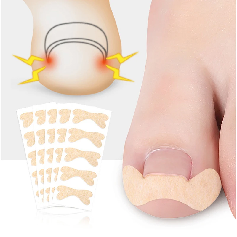 

Ingrown Toenail Corrector Sticker Paronychia Treatment Fixer Recover Corrector Bunion Pedicure Foot Toe Nail Care Tool