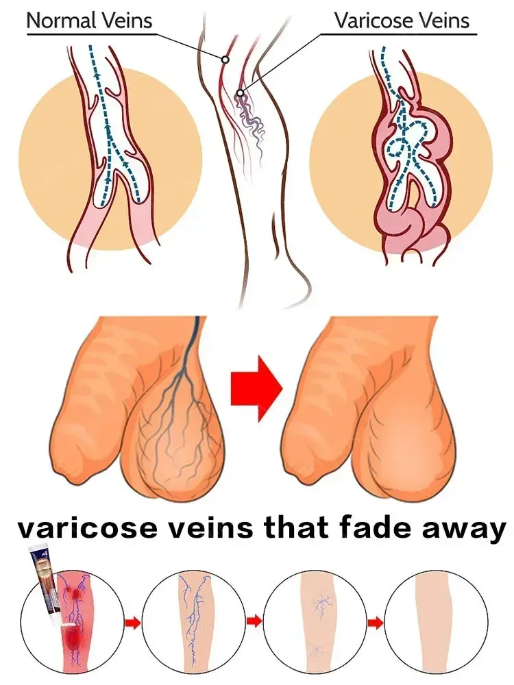 Крем против варикозного расширения вен вариесы Salep Penghilang васкутис/шиповы Tanpa Operasi