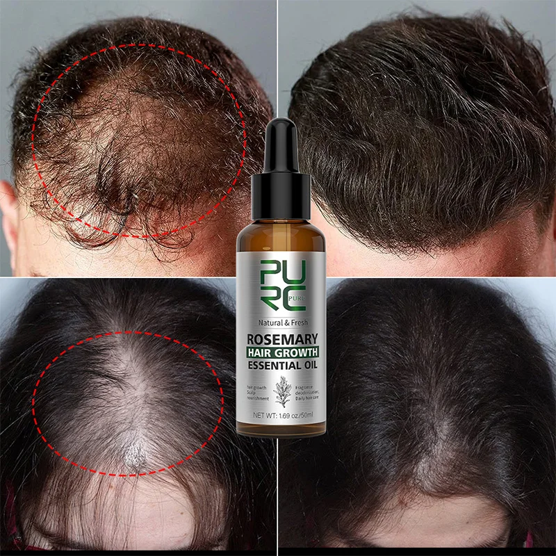 

PURC Rosemary Oil Original Hair Growth Products for Man Women Ginger Anti Hair Loss Fast Regrowth Thicken Oils Scalp Treatment