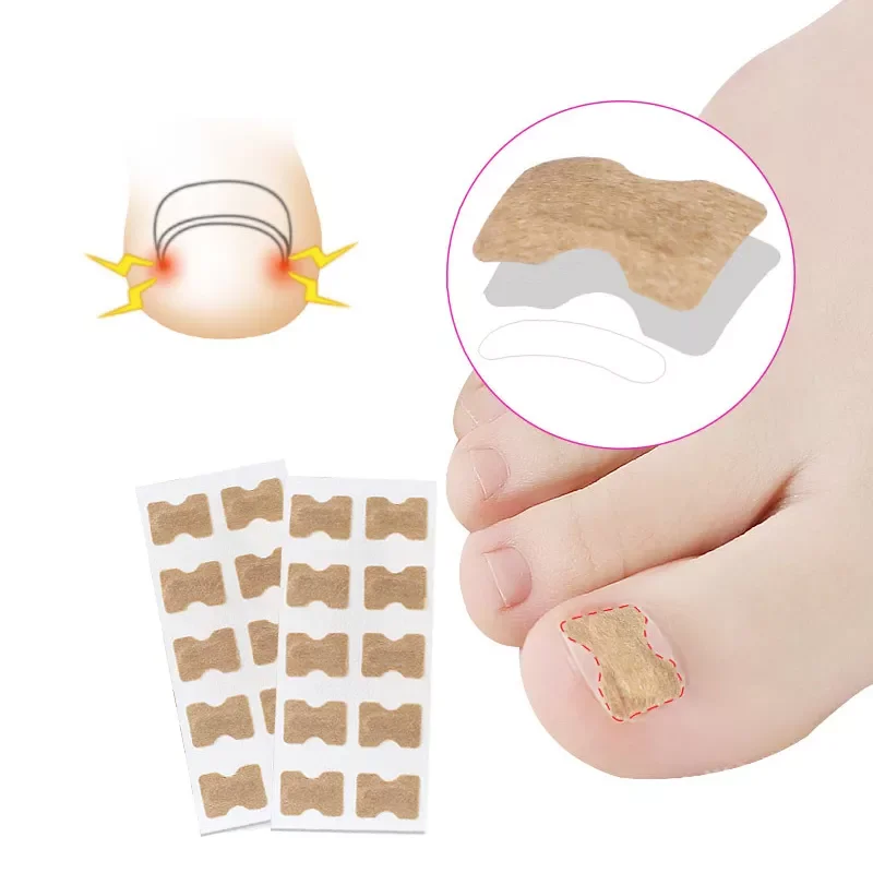 

NEW2023 Ingrown Toenail Corrector Sticker Nail Strip Anti-roll Nail Free Glue Toe Inlay Nail Corrector Patch Correction Stickers