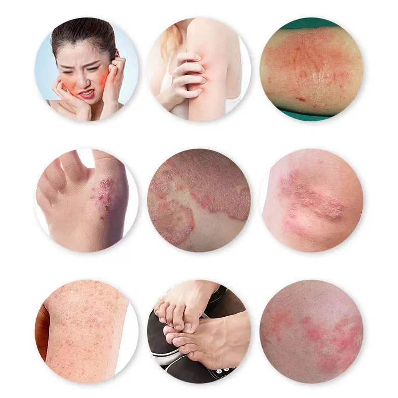 15 г/шт. крем для ухода за кожей от псориаза дерматита экземы зуда мазь медицинские