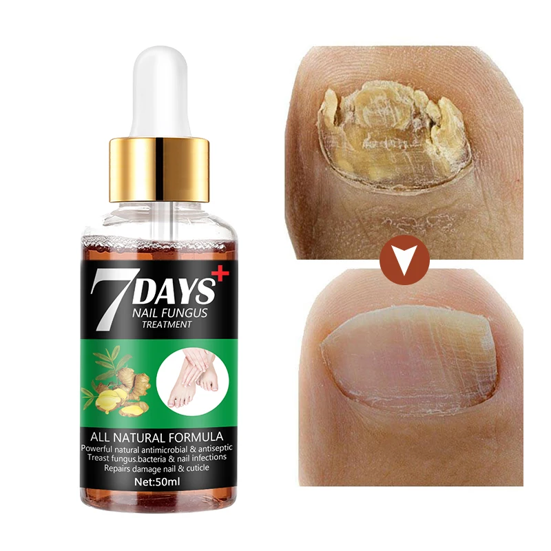

Nail Fungus Treatment Care Foot Repair Nail Fungus Removal Serum Drops Anti Infection Paronychia Onychomycosis
