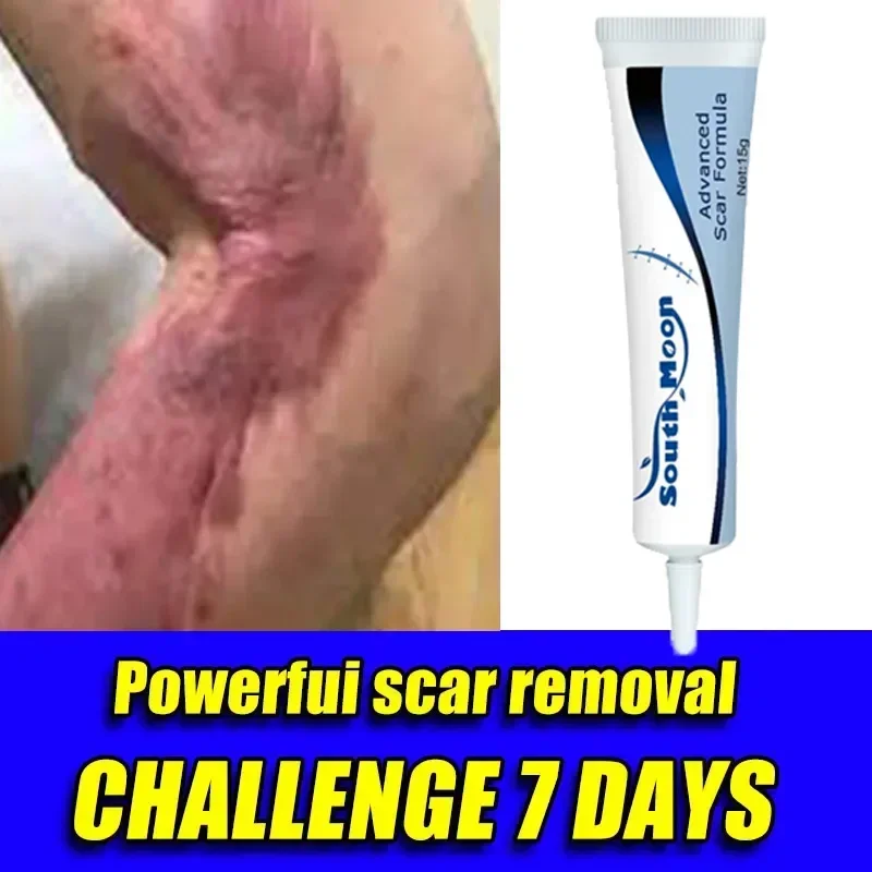 Крем для удаления шрамов от хирургических рубцов келоидов крем с-секциями 223344