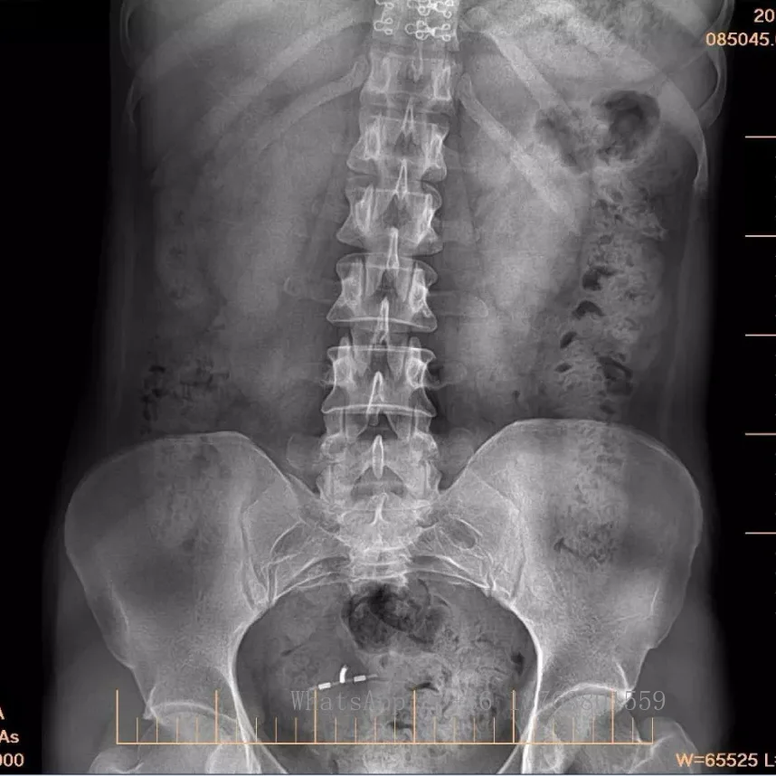Поддержка класса программного обеспечения 14*17 Беспроводная DR-радиография Xray 14x17