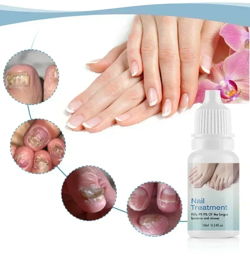 Fungal nail care massage essential oil treatment serum
