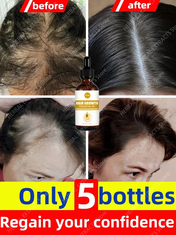 Oleo de crescimento capilar phase o cabelo crescer rapid1) repara Reismente a Calvície and Reis heredit
