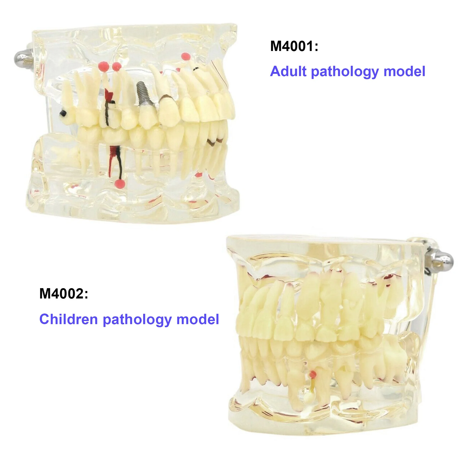

Dental Pathology Teeth Model Adult Implant/Children Carious Cysts For Dentistry Study Teach Demo Science Disease