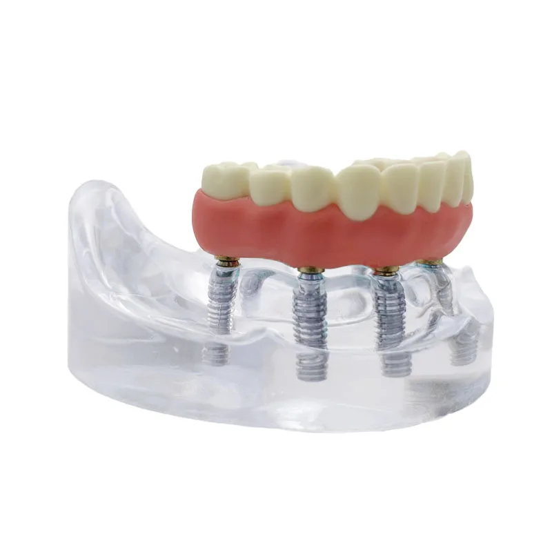 1 шт. модель зубного имплантата 6 имплантатов реставрация зубов стоматолог