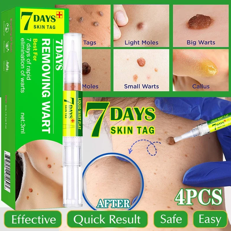 

Remover Anti Wart Remedy Liquid Pen Quickly Remove Men and Women Skin Wart Formula Skin Tag Removal Pen