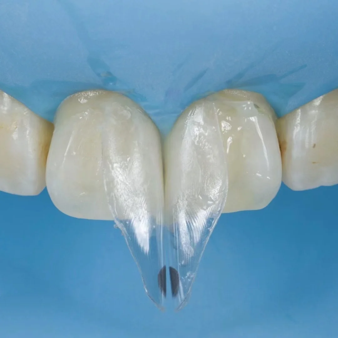 5 шт. Зубное расширение Передняя прозрачная матрица BT матрицы подходит для BioClear