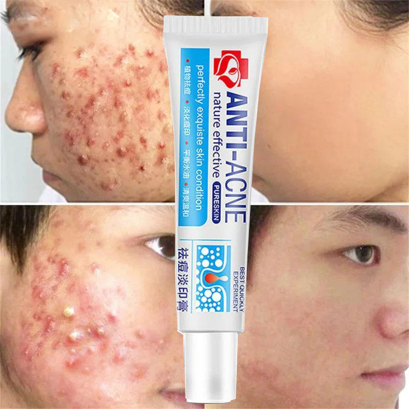 

Herbal Anti Effective Acne Removal Cream Traditional Chinese Medicine Treatment Shrink Pores Spots Gel Whitening Moisturizing