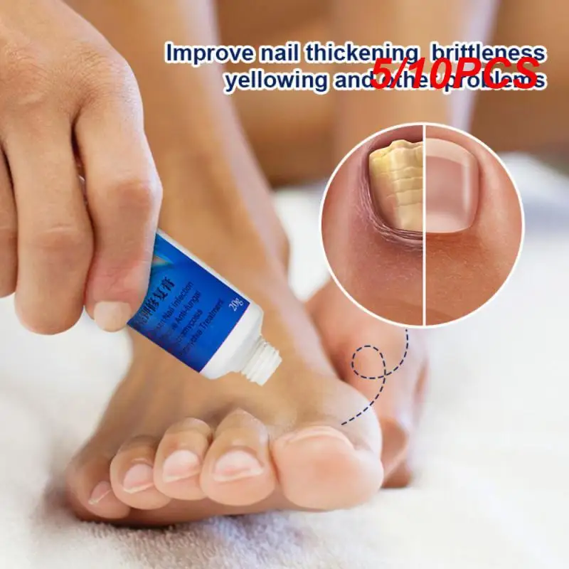 

Nail removal cream onychomycosis nail nail groove toe nail care ointment soft nail removal ointm antibacterial cream