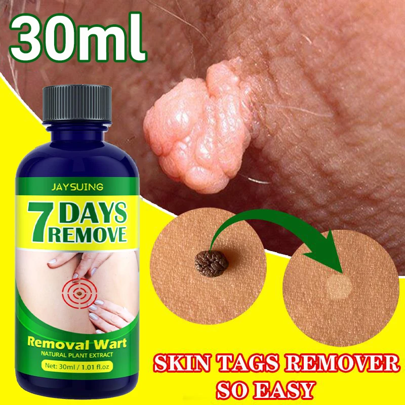 

Skin Tags Removal Serum Painless Mole Flat Wart Genital Warts Skin Dark Spots Remover Freckle Face Tags Solutions Essential Oil