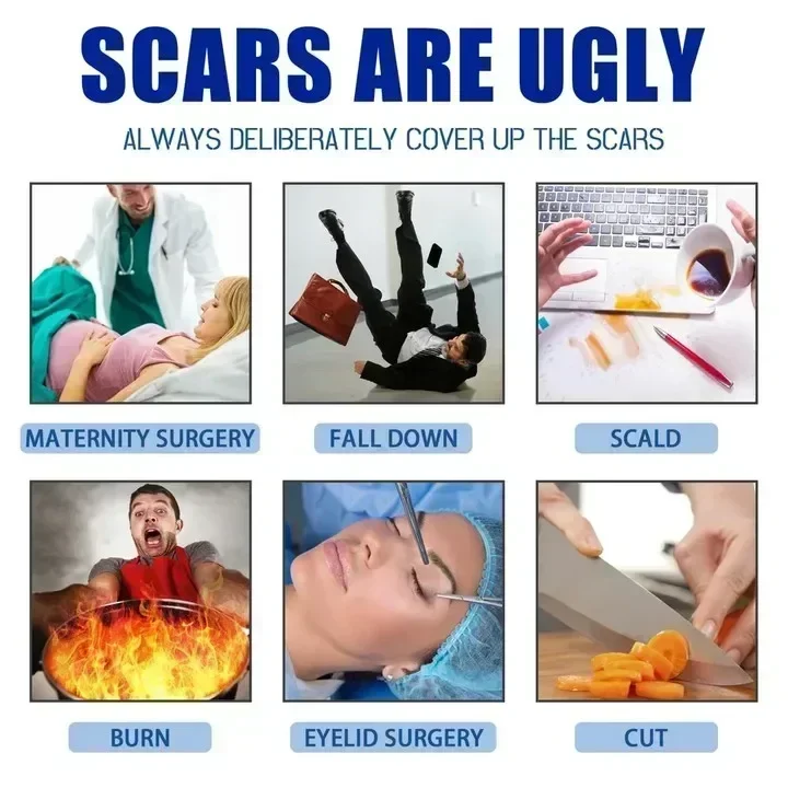 Средство для удаления растяжек после акне крем послеоперационного