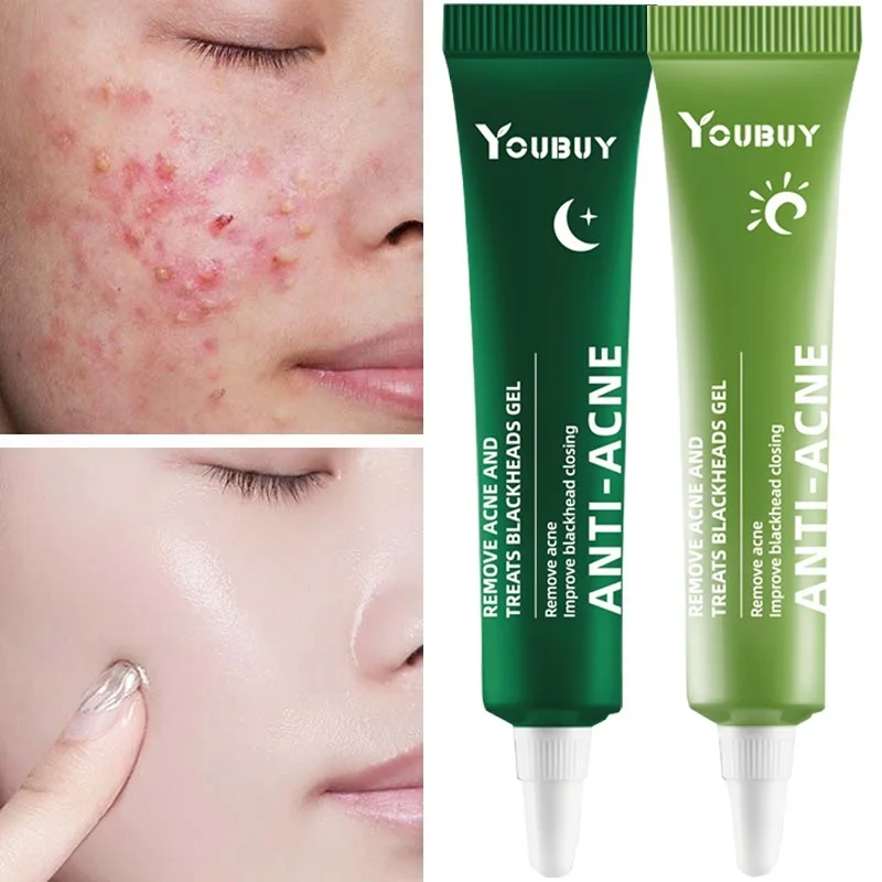 Acne Removal Whitening Cream Effective Fade Acne Spots Repair Gel Oil Control Moisturizing Shrink Pores Acne Treatment Skin Care