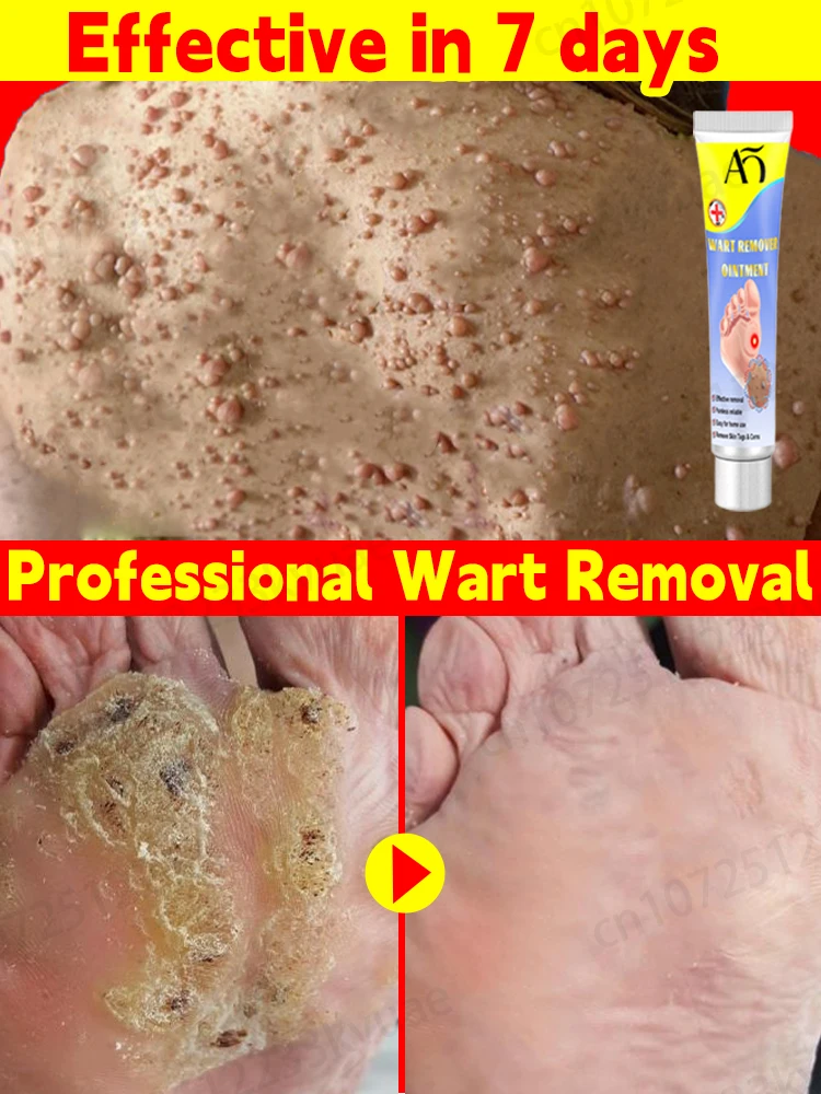 

Wart removal genital warts hpv plantar warts ommon warts flat wart skin tag wart remover ointment