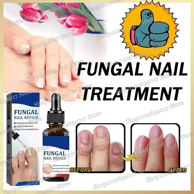 Раствор для восстановления ногтей утолщение яркие ногти удаление онихомикоза