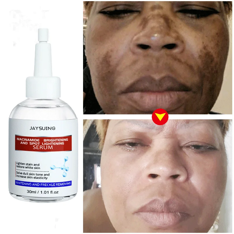 Effective Whitening Serum Remove Dark Spots Anti Freckle Fade Pigmentation Melasma Moisturizing Brighten Essence Skin Care 30g