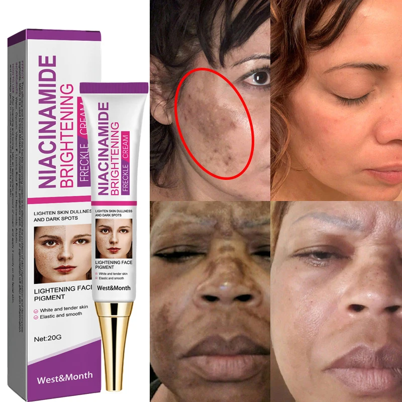 

Nicotinamide Dark Spots Whitening Cream Brightening Melanin Melasma Blemishes Pigmentation Acne Marks Face Whitening Cream Women