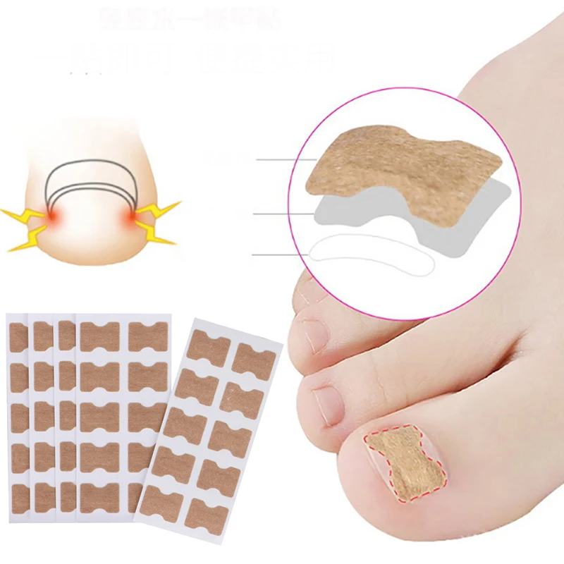 

20/30Pcs Ingrown Toenail Correction Tool Toe Nail Treatment Patch Sticker Paronychia Treatment Recover Corrector Pedicure Tools