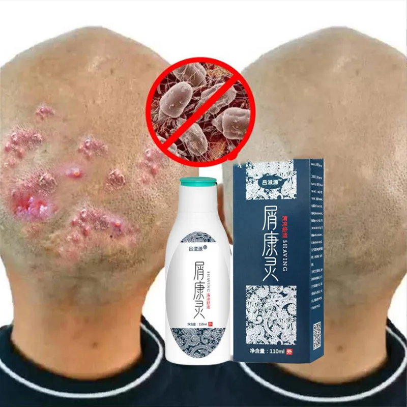 

110ML Garlic Ginger Therapeutic Shampoo Anti-Dandruff Treatment Itching and Flaking Scalp Psoriasis Seborrheic Dermatitis