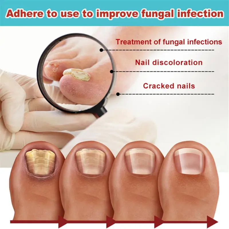 

Гибкая наклейка на ногти для лечения ног, уменьшает обесцвечивание паронихии, удаляет хрупкие ногти, противогрибковая