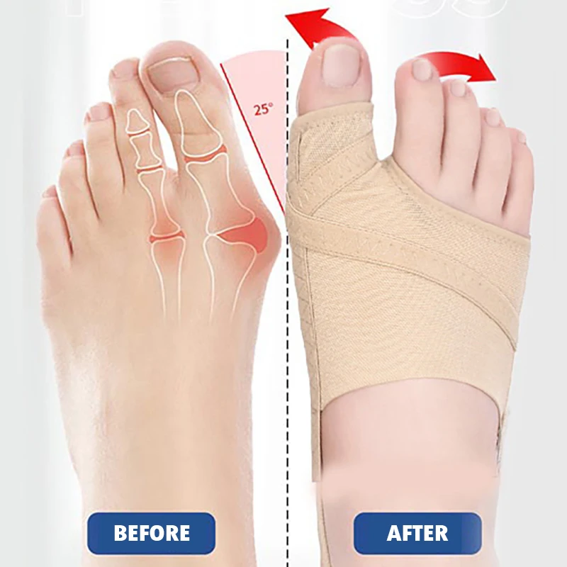 1Pair Big Toe Separator Bunion Corrector Hallux Valgus Correction Device Bone Thumb Orthopedic Forefoot Pad Foot Straightener
