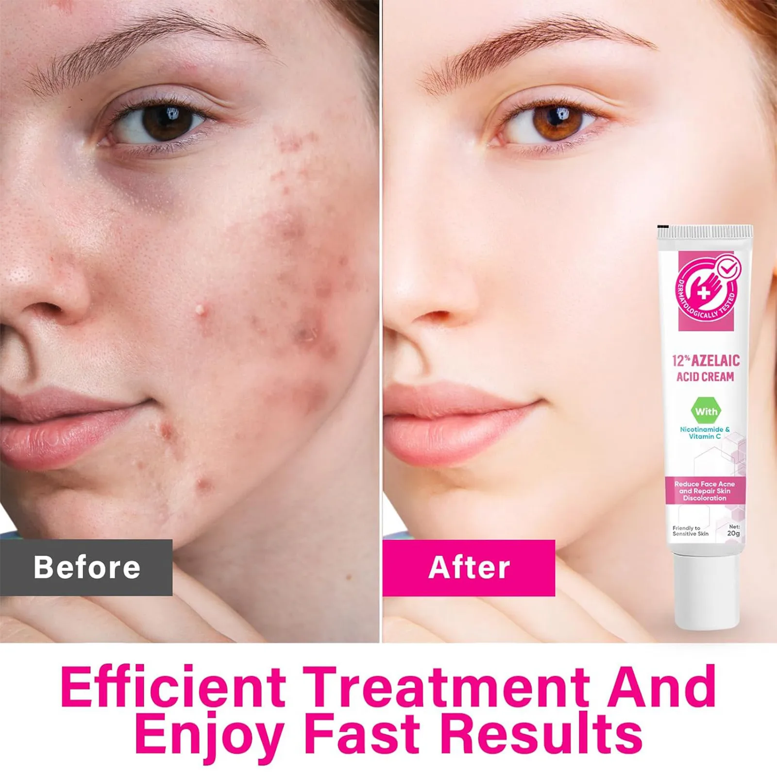 Премиум 12% Крем С Азелаичной Кислотой Для Лечения Прыщей Облегчения Покраснений