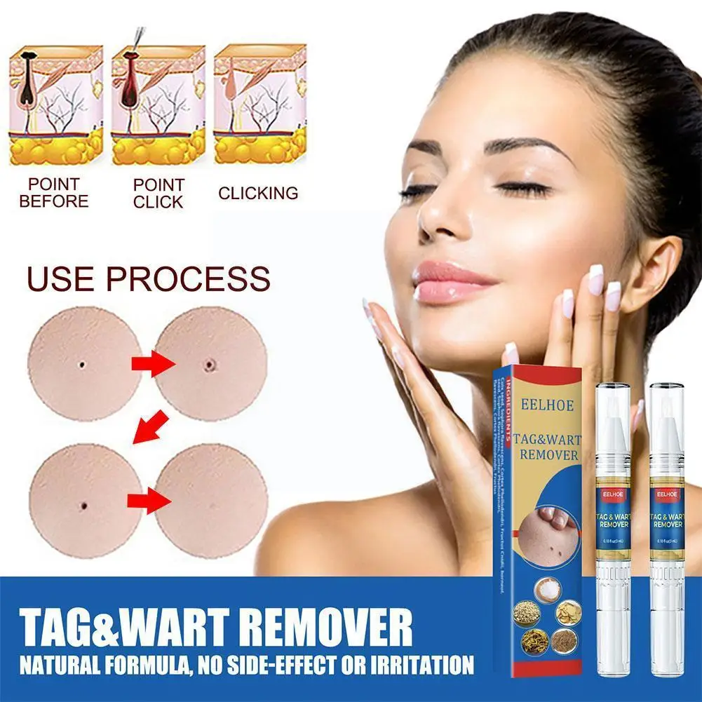 

3ml/6ml Wart Removal Ointment Wart Treatment Liquid Removal Tag Remover Pen Wart Warts Liquid Against Remove Skin Ointment H9e3