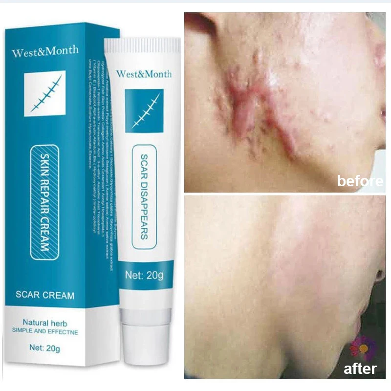 

Herbal Scar Removal Cream Fade Stretch Marks Remove Acne Spots Burn Surgical Scar Treatment Smooth Whitening Face Body Skin Care