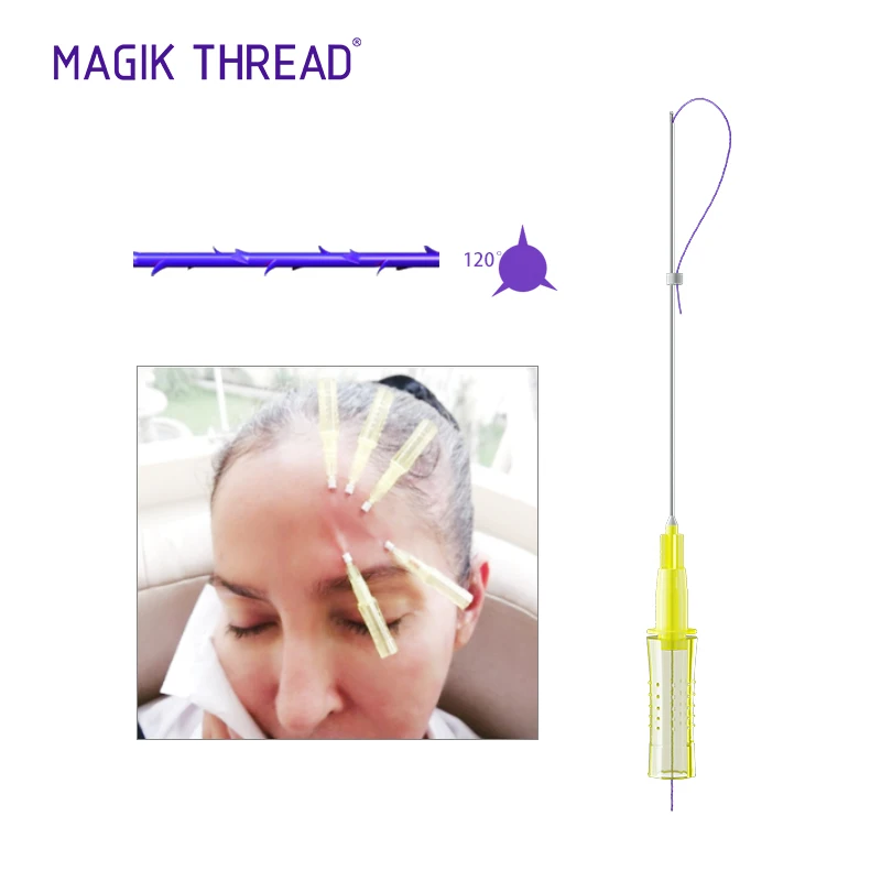 

Нить Magik Ce Cog 4D, зубчатый шов с L-Cannula 19 г * 100 мм, проволока, фактологическая подъемность, Hilos tenзвуковая резьба Pdo
