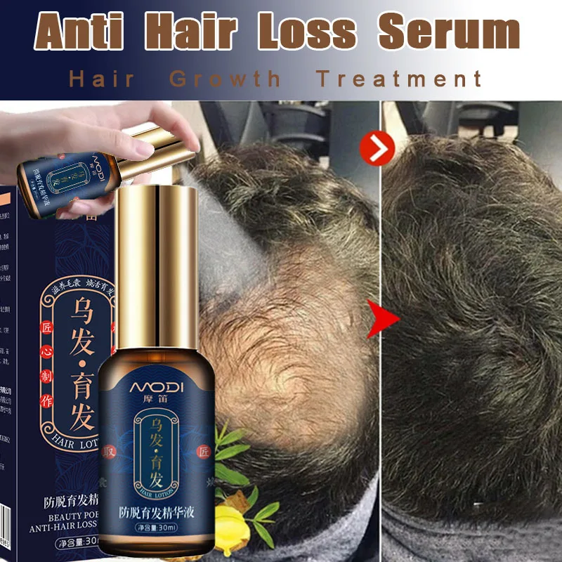 

30ml Ginger Hair Growth Serum Natural Hair Growing Spray Fast Prevent Hair Loss Hair Care Oil Treatment Scalp Hair Follicle