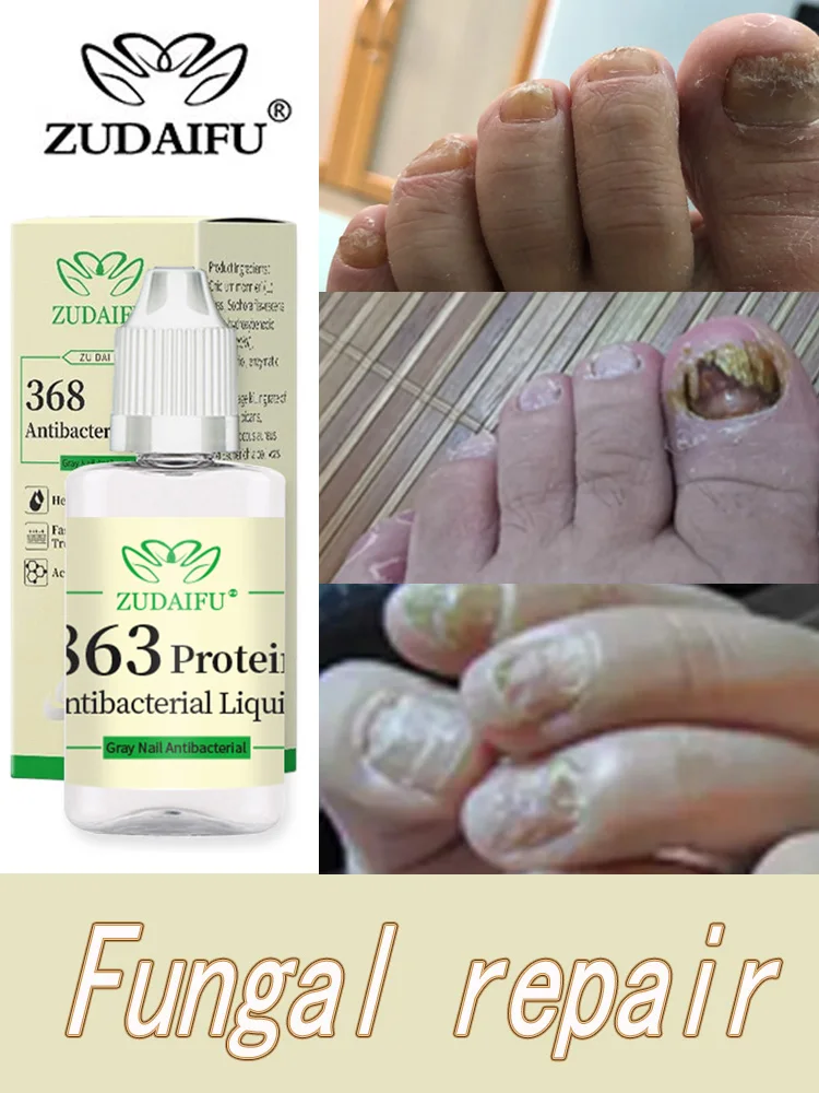 

ZUDAIFU Foot Nail Fungus Treatment Serum Anti Fungi Feet Care Against Fungal Nail Polish Oil Antifungal Drops Removes Gel 20ml
