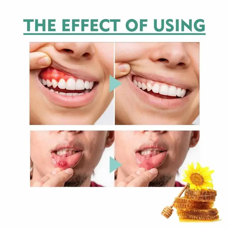 Спрей для зубной боли спрей полости рта снимает опухшие десны кровотение зубов