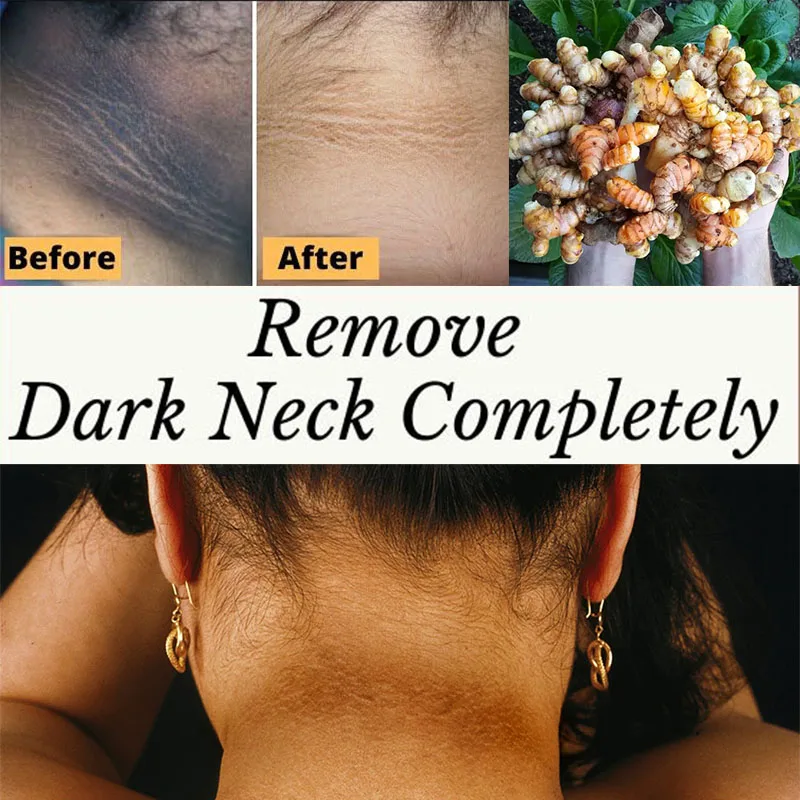 

Куркума избавляет от темной куркумина для шеи, уменьшает выцветание пигментации, салициловая кислота, отшелушивающие средства, удаляют оме...