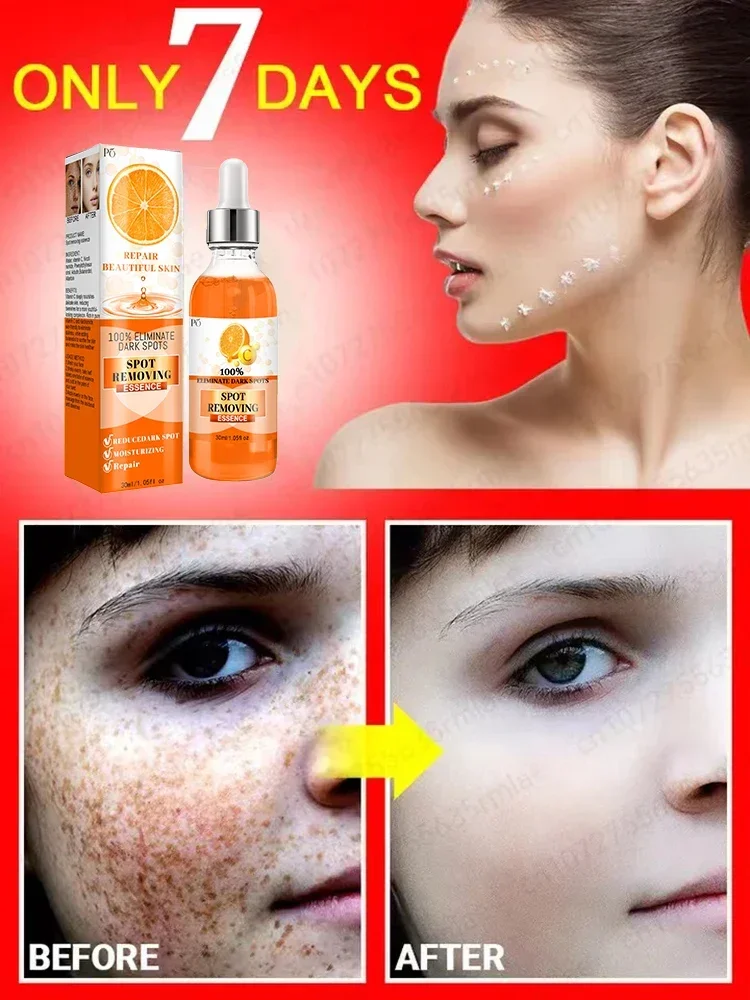 

Fast Freckles Removal Facial Essence Remove Facial Spots Skin Dark Spot Remove Melasma Sunspots Whitening Freckle Removing