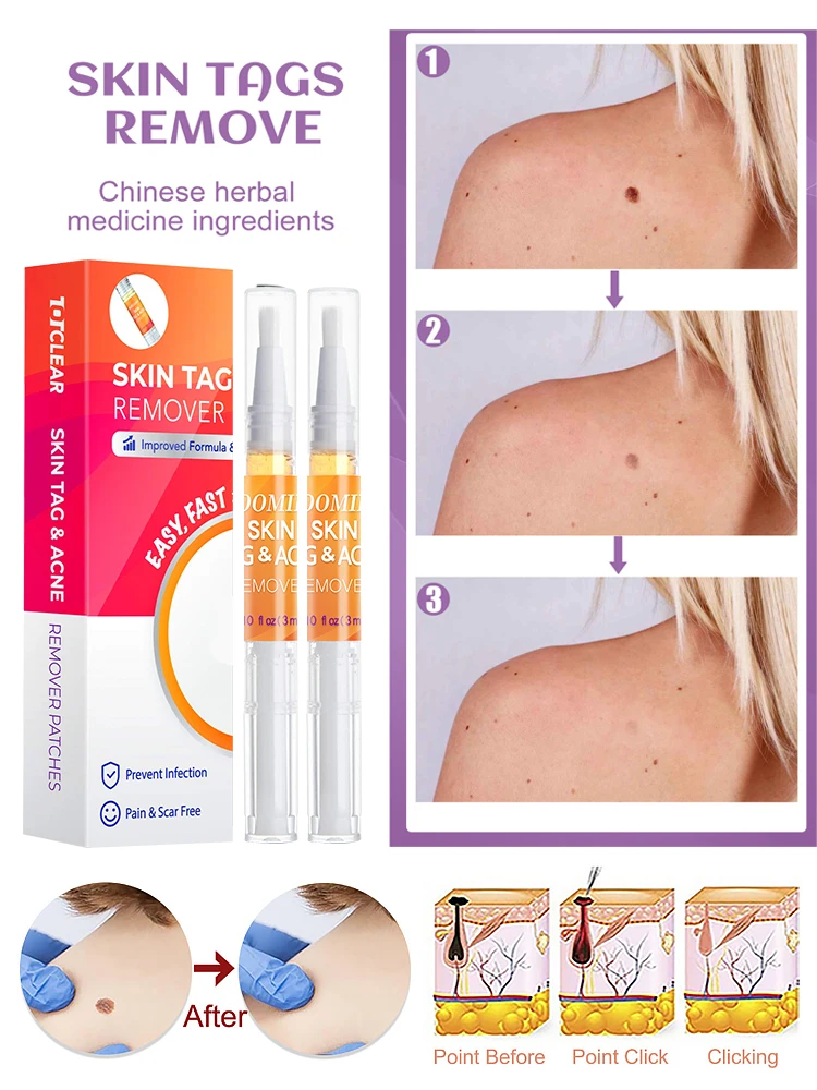 Флуоресцентная ручка для удаления бородавок с кожей жидкая лечения папилломы 1