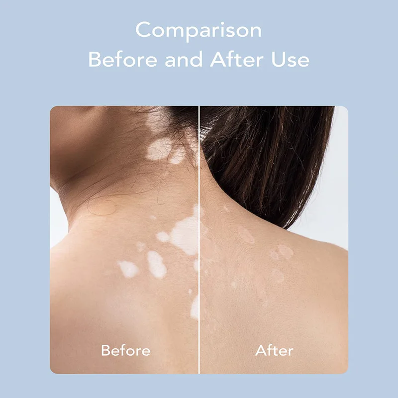 Инструмент для лазерной терапии уфв Нм