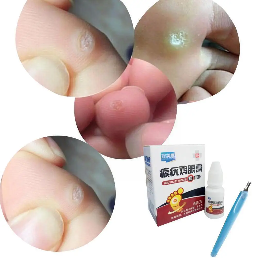 

Skin Tag Remover 12 Hours Treatment Remover Against Mole Care Corns Skin Wart Knife Ointment Pedicure Wart Body Tag Corns N1h5