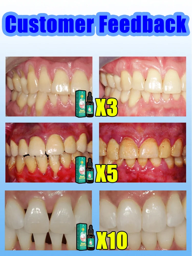Регенерация атрофии регенерации десен отеки и удаление боли черные треугольники