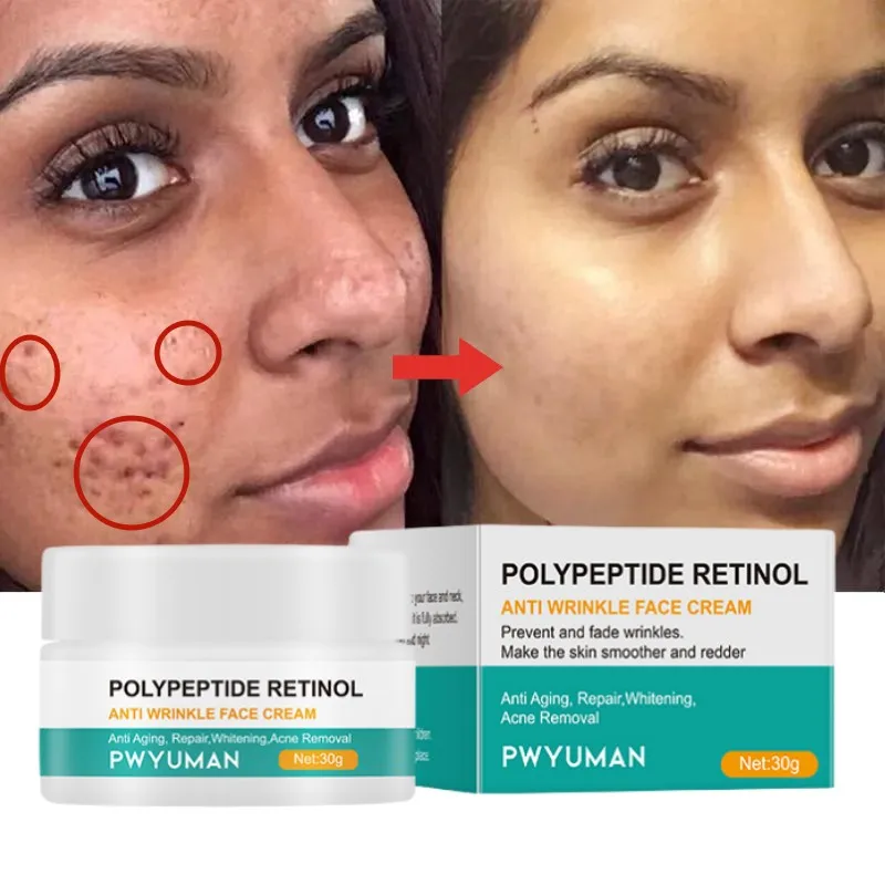 

Acne Removal Anti-Wrinkle Cream Shrink Pores Moisturise Oil Control Pimples Acne Treatment Reduces Fine Lines Face Skincare