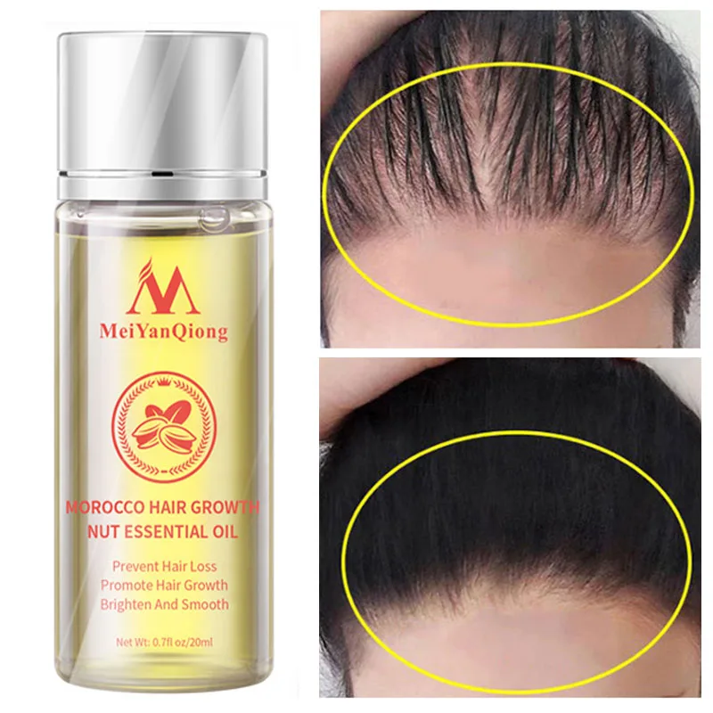 

Sdotter Moroccan Hair Growth Nut Essential Oil Product Anti Hair Loss Treatment Serum Care Dry Frizz Repair Damage Nourish Hair