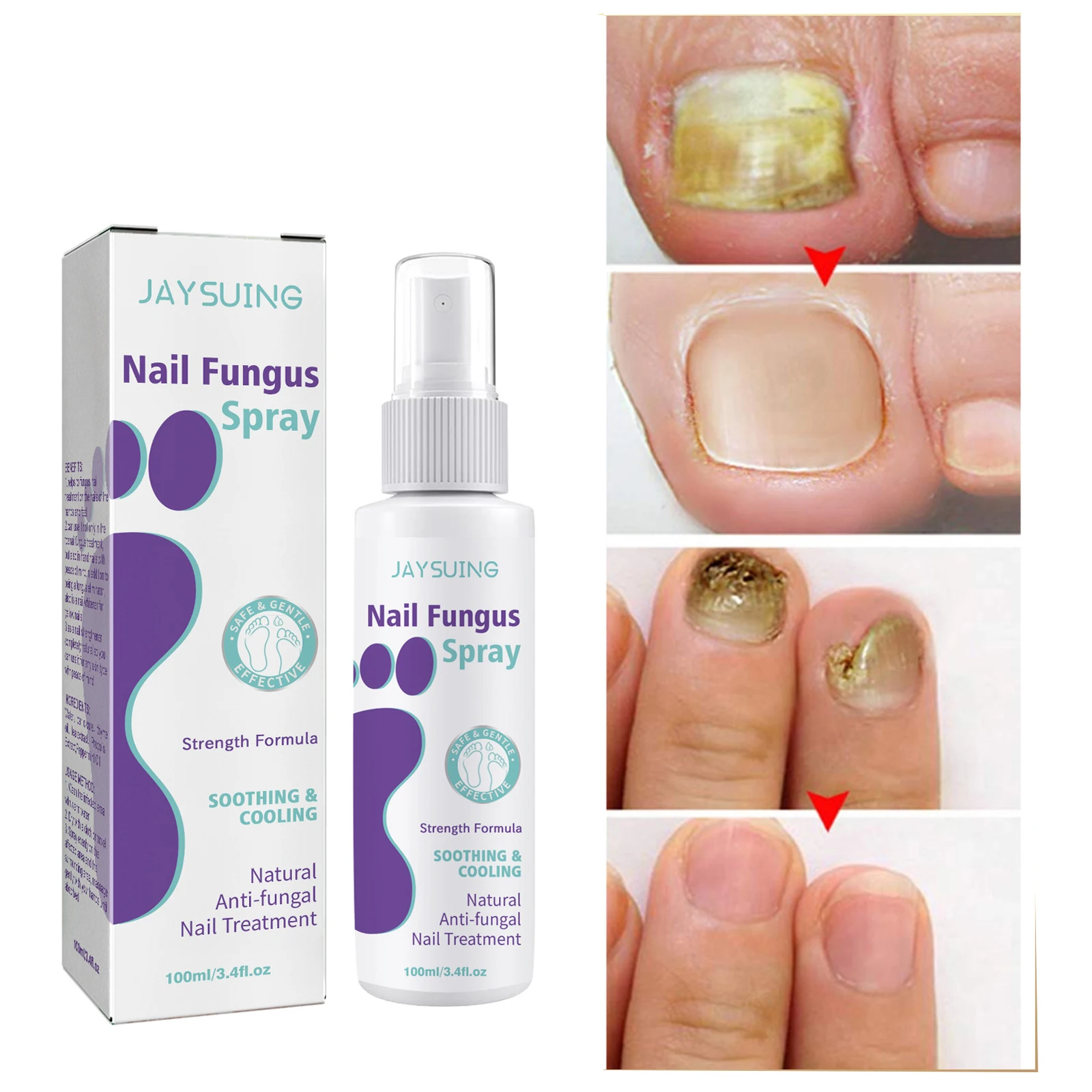 

Средство для лечения грибка ногтей, семейная онихомикоз, паронихия, анти-инфекция, для рук, ног, ног, удаление грибка, Восстанавливающее Средство для ухода за ногами