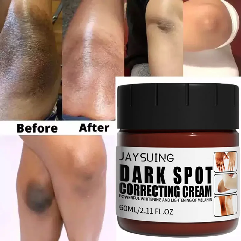 

Get Rid Of Dark Knuckles In 7 Days Cream Whitening Removing Dark Knuckles Serum Hand Knuckle Eraser Lotion for Elbow and Knee