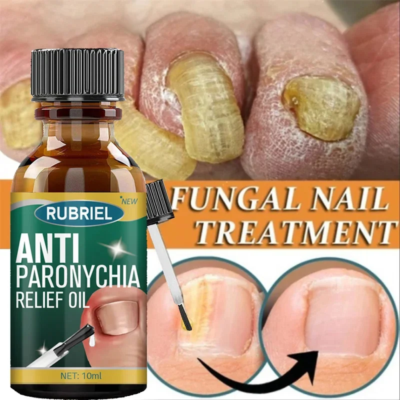 Сыворотка для лечения грибка ногтей ремонтный гель удаления против инфекции