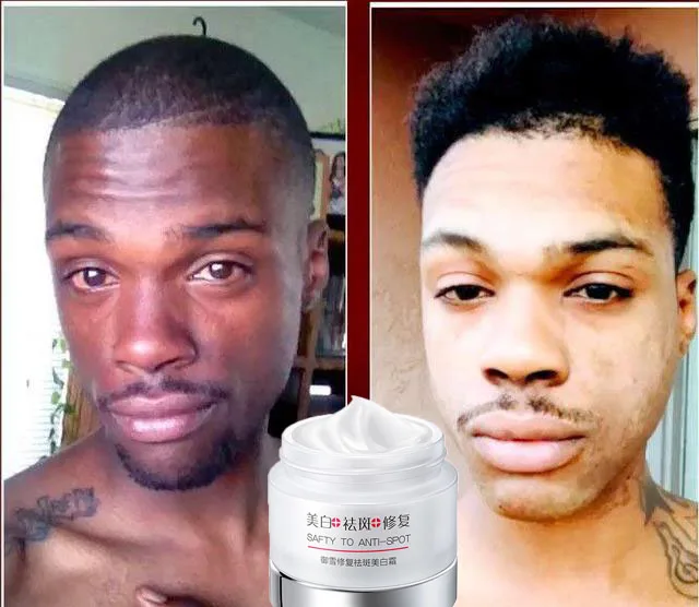 

Травяной отбеливающий крем для лица, удаление пигментации, мелазма, пигмент меланин, темные пятна, солнечные ожоги, Kojic кислота, Осветляющий ...