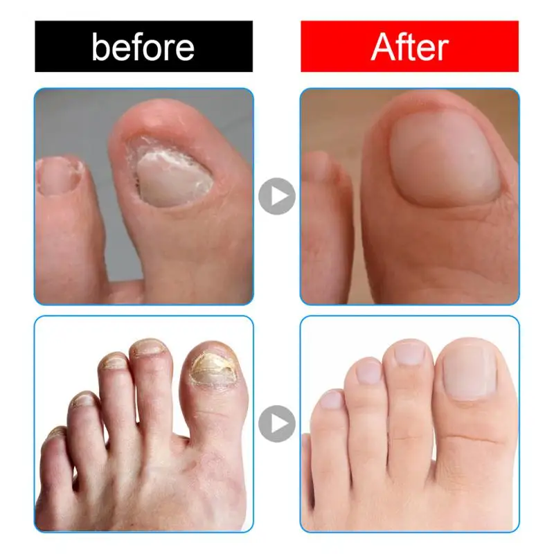

Nail Correction Stickers Ingrown Toenail Corrector Patches Paronychia Recover Corrector Pedicure Tools