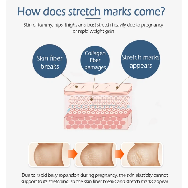 30g Postpartum Recovery Treatment Stretch Mark Pregnancy Scar Body Creams Nourishing Essence Mild Tender Obesity Pattern Remover |