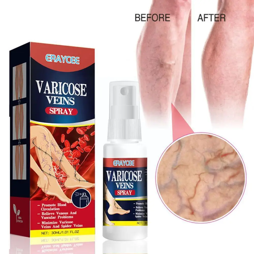 

Spray for varicose veins Effective varicose vein relief cream to relieve Leg vasculitis phlebitis spider pain swelling trea Y0P8